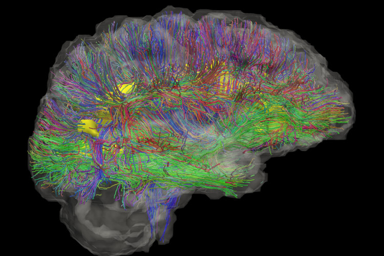 A brain with brain activity mapped in different bright colours against a black background