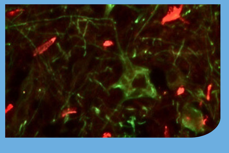 Motor neurons in green and blood vessels in red in a healthy and an SMA sample of spinal cord. The lack of blood vessels in SMA is apparent, and one of the key focusses of the recent grant funding.